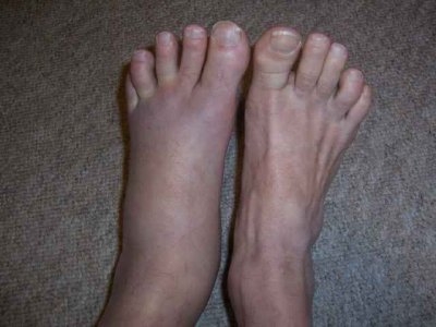 Ankle 1i.jpg