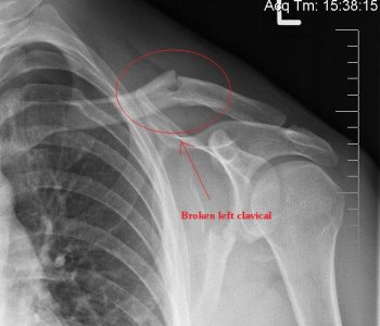 collar bone.jpg